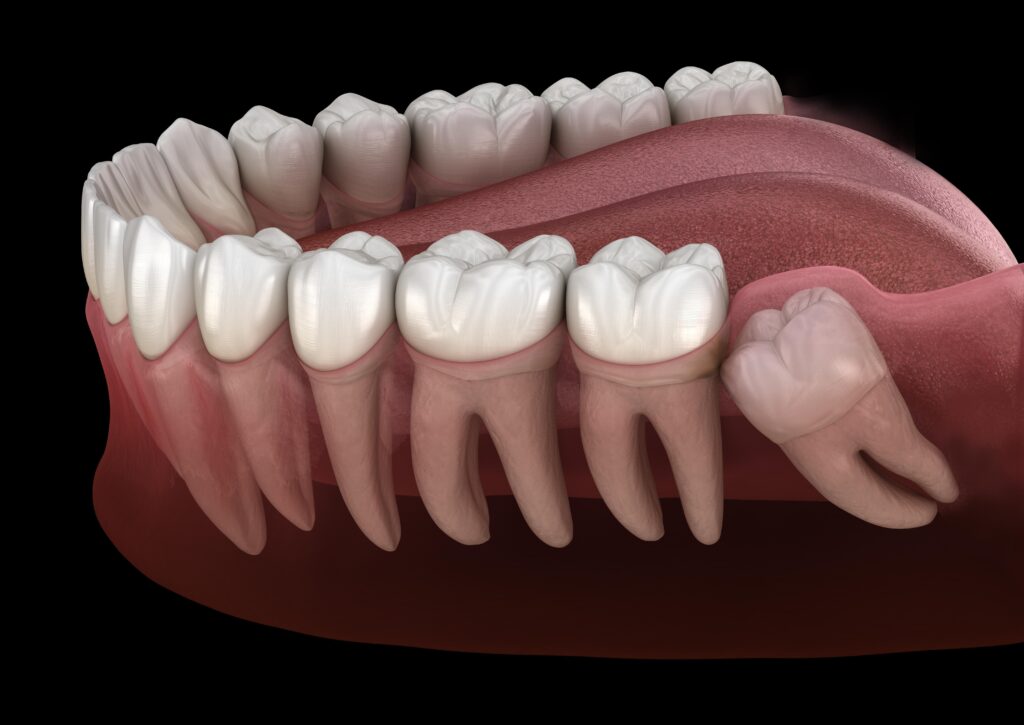 Why Wisdom Teeth Become Impacted — And Why That Matters